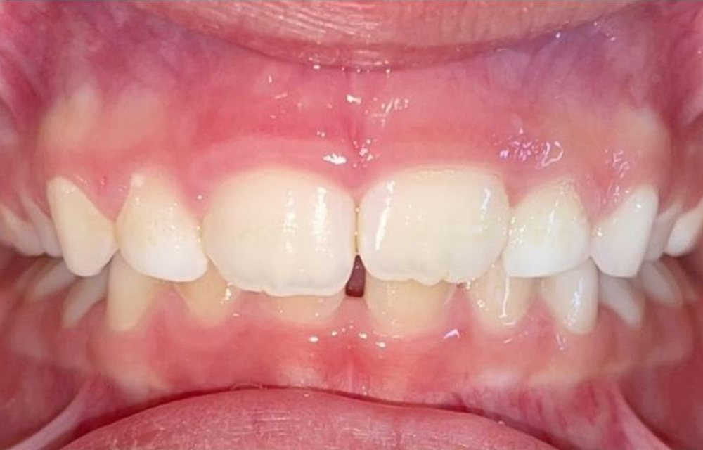 Dentes da mesma criança depois do tratamento
