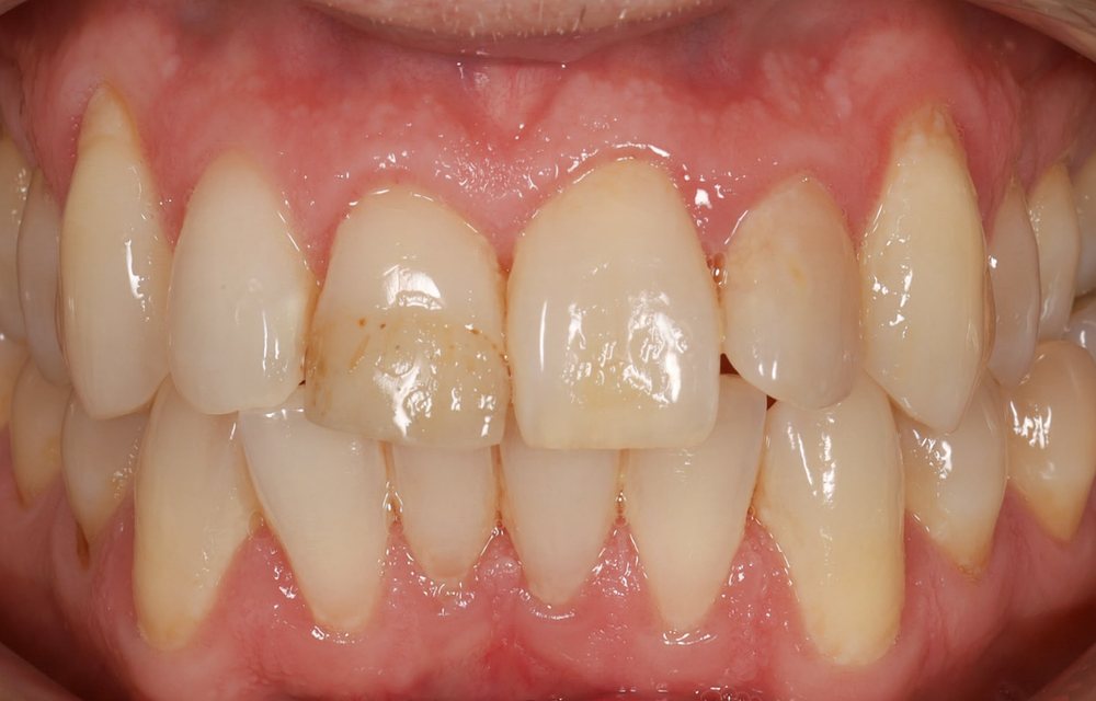 Dentes de um adulto antes do tratamento