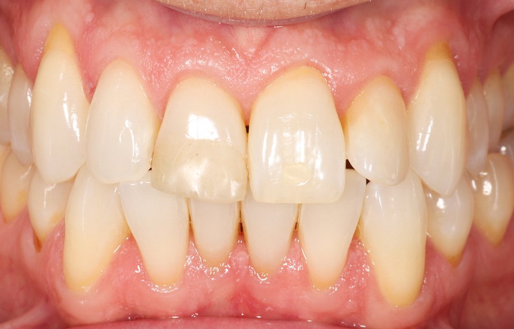 Dentes do mesmo adulto depois do tratamento
